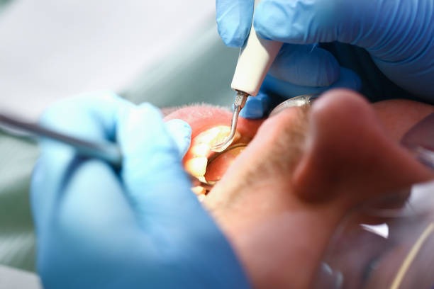 Best Root Canal Emergency Dentist  in Palm City, FL